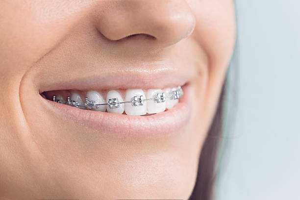 Best Traditional Braces  in Bucyrus, OH